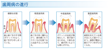 歯周病はどんな病気かご存じですか?