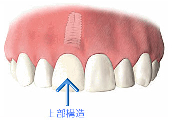 3~4ヶ月後に支台部(頭の部分)を取り付け
