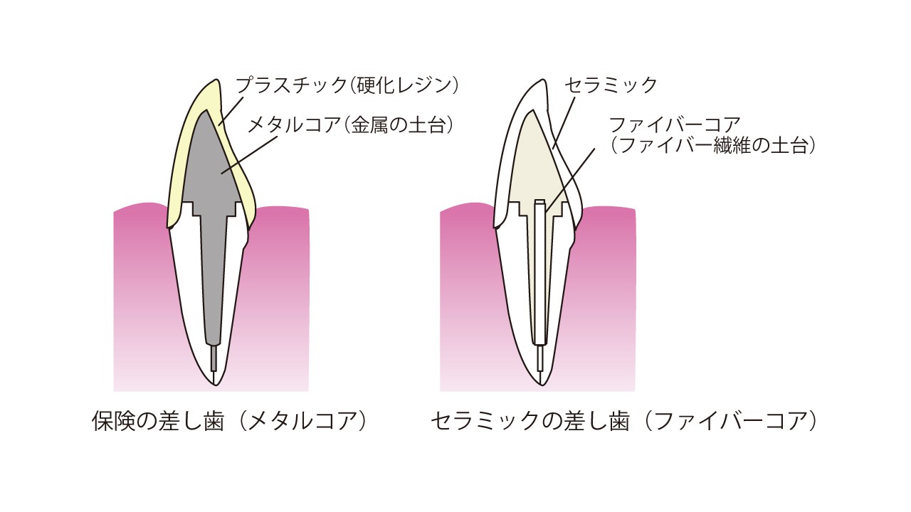 差し歯コア