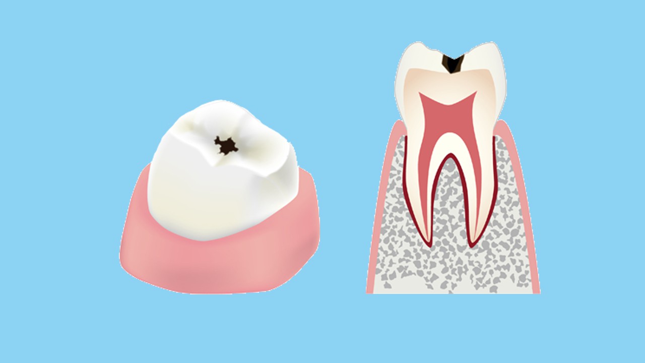 気付かない間に 虫歯の進行について 東大阪の歯医者