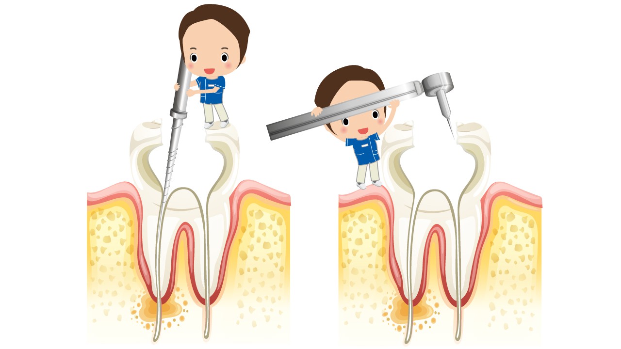根管治療2
