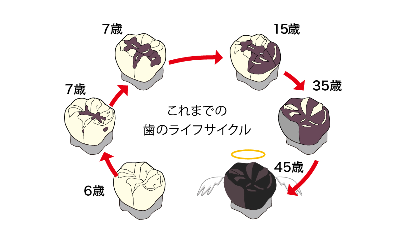 歯のライフサイクル - 【公式】伝えたい歯医者のお役立ちブログ by東大阪のりょうき歯科