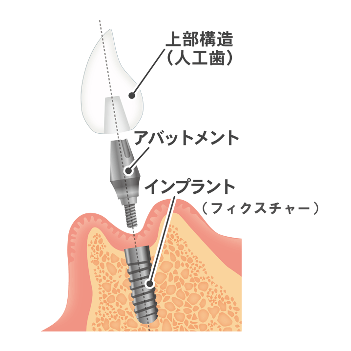 インプラントの構造