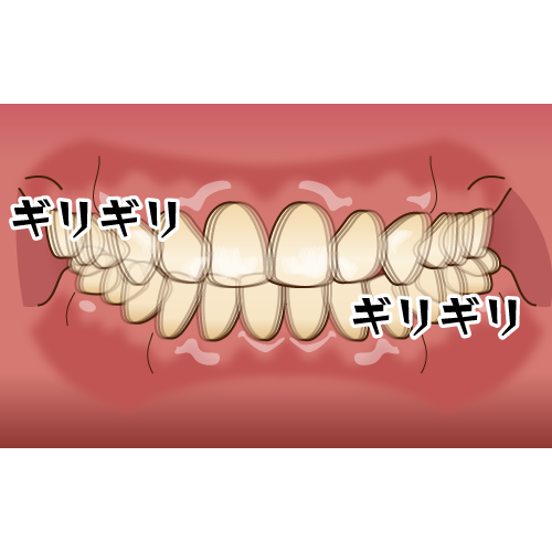 咬み合わせ調整