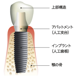 インプラント