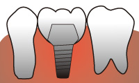 1本単独でのインプラント