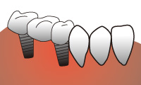 ブリッジでのインプラント