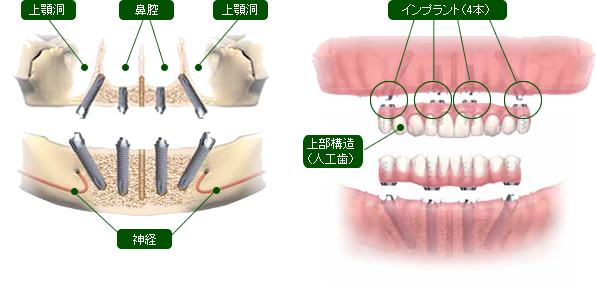 All-on-4は、4本のインプラントで10本から12本を支える治療法