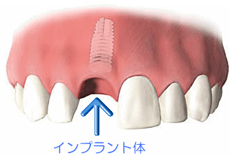 インプラント体を埋入するための孔を形成します。