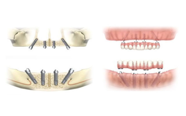All-on-4（総入れ歯をお使いの方や多くの歯をなくした方のためのインプラント治療方）