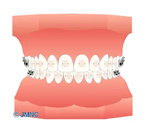 ワイヤー矯正の矯正装置（クリアブラケット）