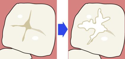 シーラント処置の前と後の画像